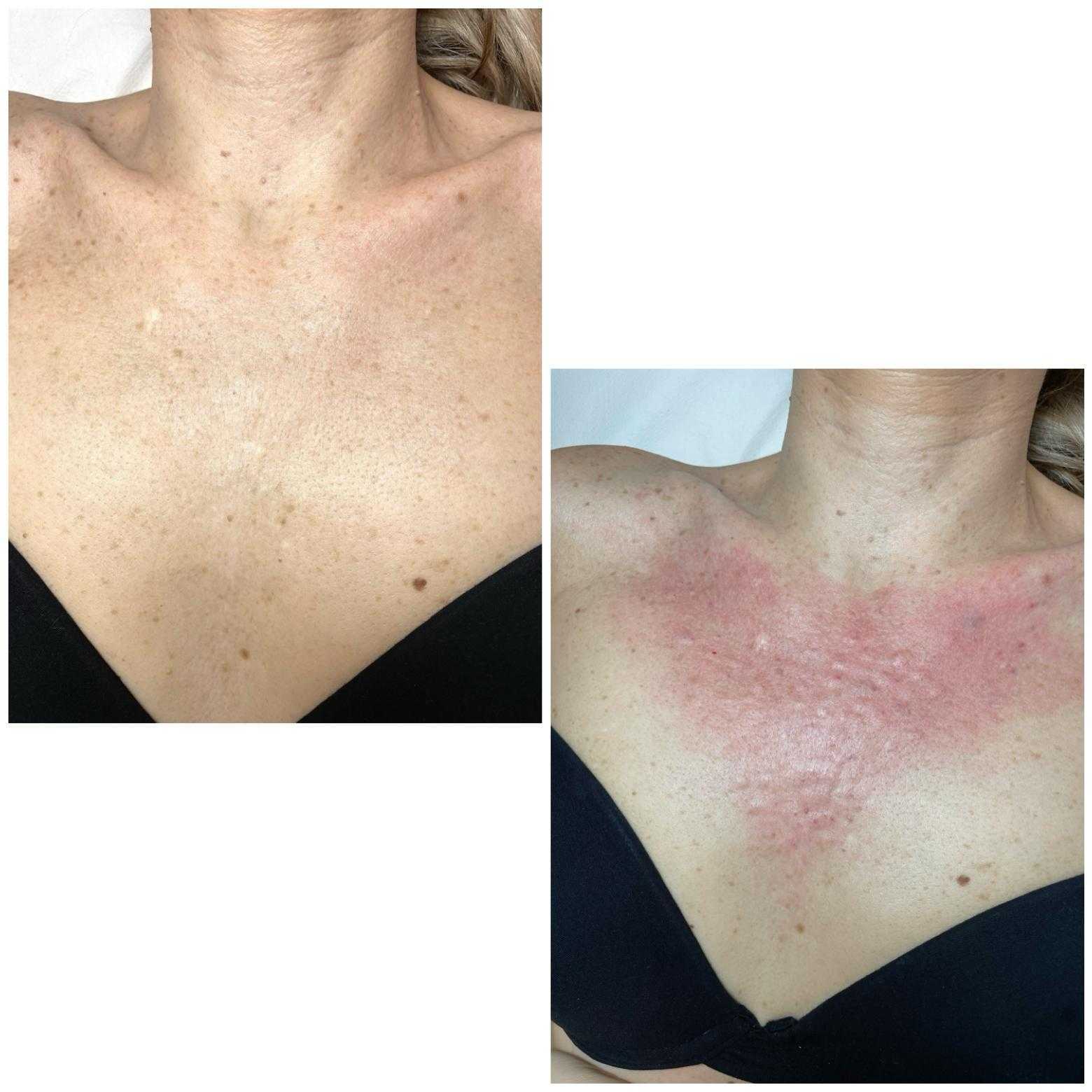 polinucleotidos en Zaragoza, antes y después